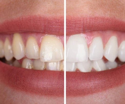 Happyteeth™ | Geniet zonder risico van een stralend witte glimlach! | 1+1 GRATIS